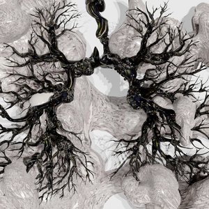 Sarcoidosis