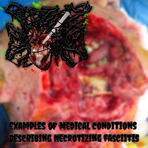 Examples of Medical Conditions Describing Nectotizing Fasciitis