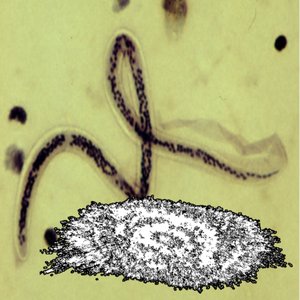 Filariasis