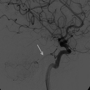 Subarachnoid Haemorrhage