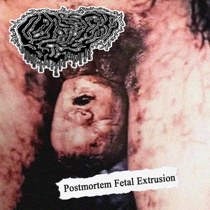 Postmortem Fetal Extrusion