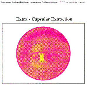 Extra‐Capsular Extraction