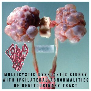 Multicystic Dysplastic Kidney With Ipsilateral Abnormalities Of Genitourinary Tract