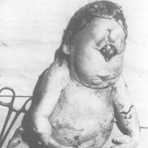 Alobar Holoprosencephaly