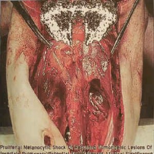 Proliferal Melanocytic Shock of Recurring Tumorigenic Lesions of Uncertain Pulmonary Potential and Malignant Atypical Significance