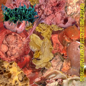 The Gross Appeareance For Multicystic Renal Dysplasia