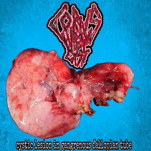 Cystic Lesion in Gangrenous Fallopian Tube