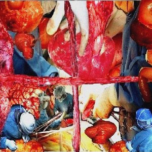 A Biogangliocystadenomyostomic Sado-Surgery