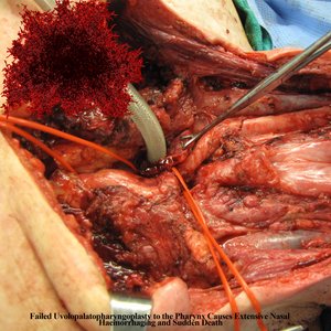 Failed Uvolopalatopharyngoplasty to the Pharynx Causes Extensive Nasal Haemorrhaging and Sudden Death