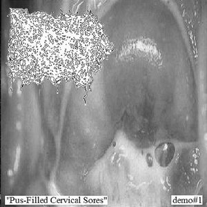 Pus-Filled Cervical Sores