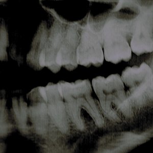 Screloma