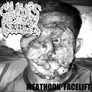 Meathook Facelift