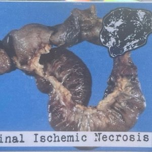 Intestinal Ischemic Necrosis
