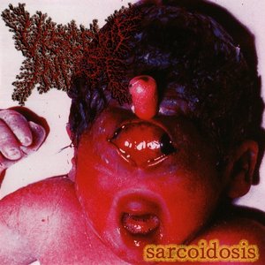 Sarcoidosis