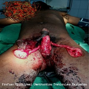 Profuse Epididymal Obstruction Testicular Explosion