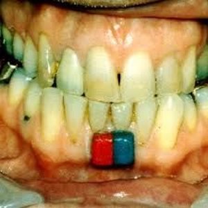 Bleeding Gums
