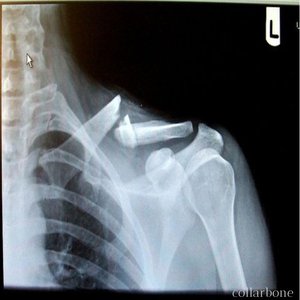collarbone