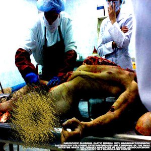 endoscopic duodenal erosion with immunohistochemical gastropathy following cryptosporidiosis and lymphoma of the small intestine which are primary indicators of gastric adenocarcinoma microscopy in a emasculated corpse