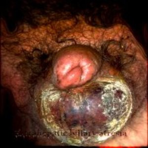 Extrahepatic Billary Atresia