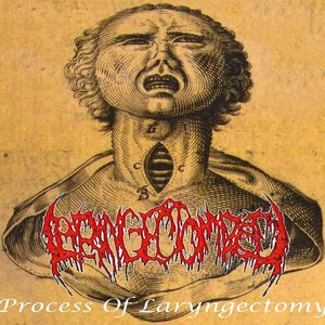 Process Of Laryngectomy