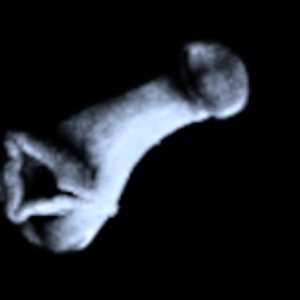 Schistosomiasis 的头像