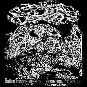 Rotten Esophagogastroduodenoscopy preparation