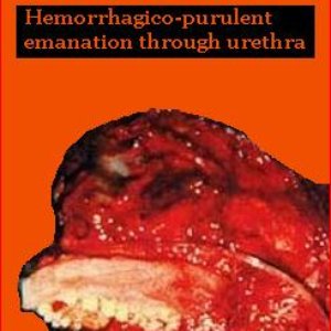 Hemorrhagico-Purulent Emanation Through Urethra