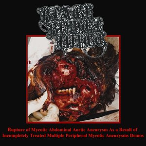 Rupture of Mycotic Abdominal Aortic Aneurysm as a Result of Incompletely Treated Multiple Peripheral Mycotic Aneurysms Demos