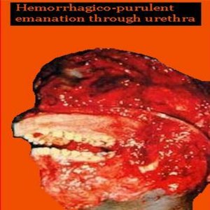 Hemorrhagico-Purulent Emanation Through Urethra