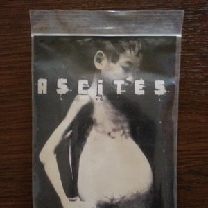 Ascites
