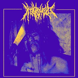 Subdural Hematoma (Demo)