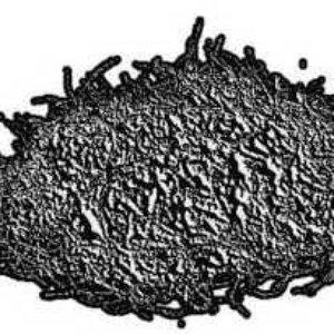 Avatar for Hematocolpos Drained From Imperforate Hymen