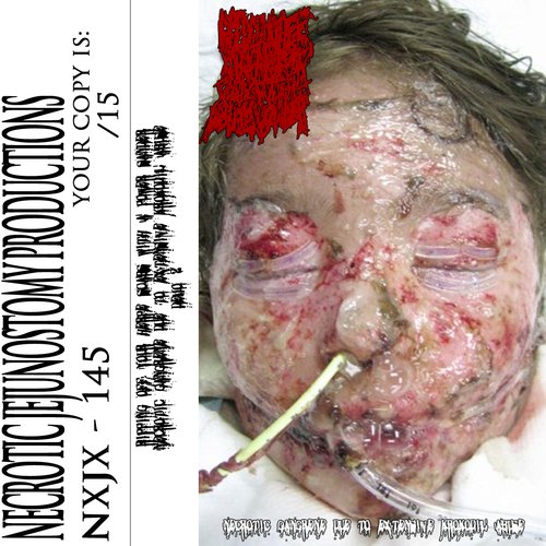 Necrotic Gangrene Due to Extensive Krokodil Abuse