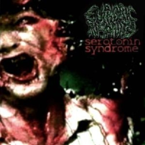 Serotonin Syndrome