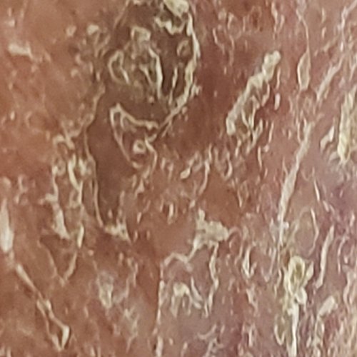 Cellulitis