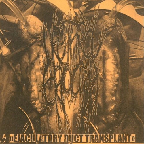 Ejaculatory Duct Transplant