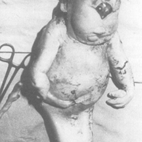 Alobar Holoprosencephaly
