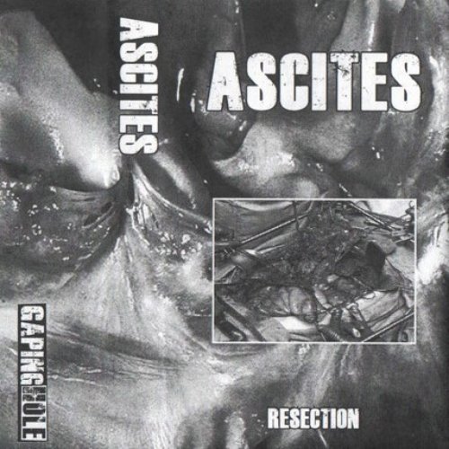 Resection