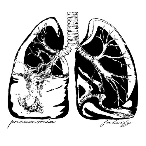 Pneumonia / Falsify