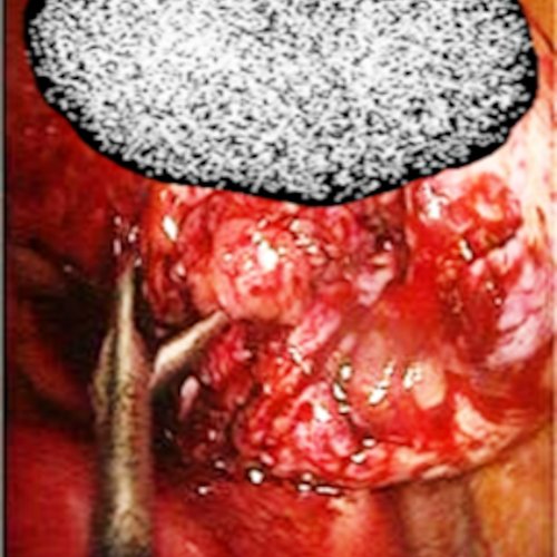 Splanchnopleuriticexenteration