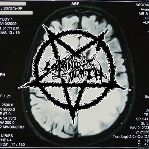 Braincancer
