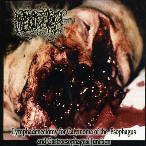 Lymphadenectomy For Carcinoma Of The Esophagus And Gastroesophageal Junction