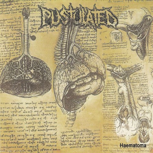 Haematoma