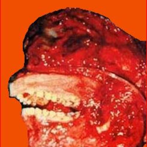 Hemorrhagico-Purulent Emanation Through Urethra