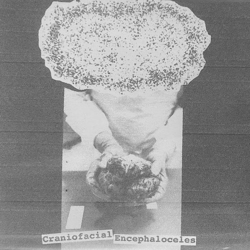 Craniofacial Encephaloceles