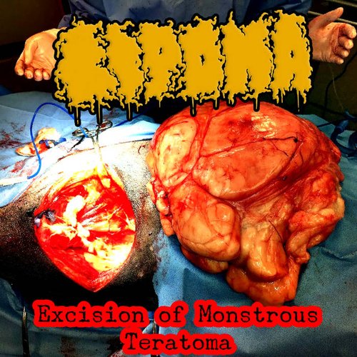 Excision of Monstrous Teratoma