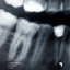 Cavity Care