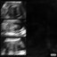 ULTRASOUND