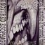 Surgical Elimination Of Periodontal Pockets