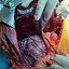 Virilising Adrenocortical Carcinoma